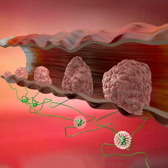 Colon Treating Bowel Conditions Tissue Proliferation Colon Cancer Rectal Cancer - COLON